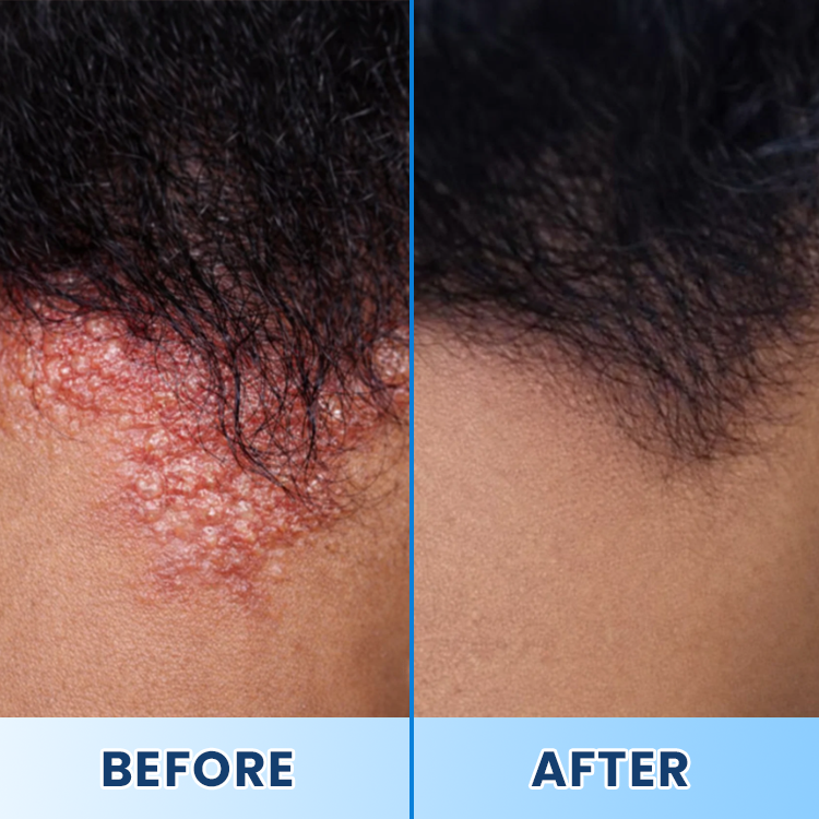 LIMETOW® Visible Beard & Scalp Relief in 7 Days Without Steroids