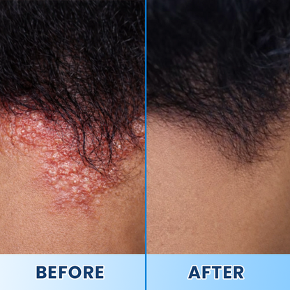 LIMETOW® Visible Beard & Scalp Relief in 7 Days Without Steroids