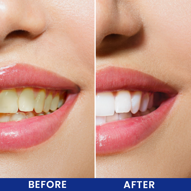 LIMETOW® Cavity Healing Tooth Armor