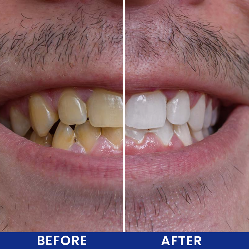 LIMETOW® Cavity Healing Tooth Armor