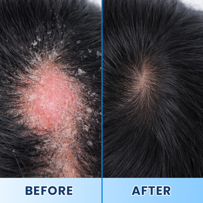 LIMETOW® Visible Beard & Scalp Relief in 7 Days Without Steroids