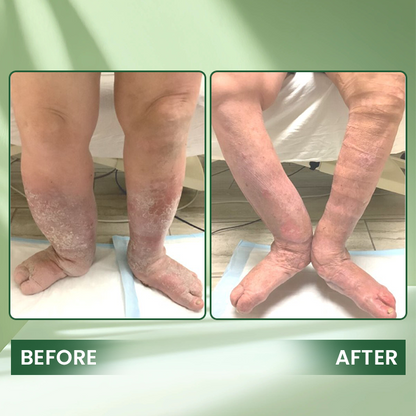 LIMETOW® Edema Relief Lotion