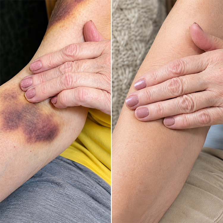 LIMETOW® Arnica Bruise Repair Oil Lotion