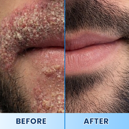LIMETOW® Visible Beard & Scalp Relief in 7 Days Without Steroids