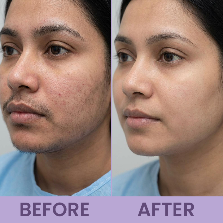 LIMETOW® Cyperus Rotundus Skin Serum