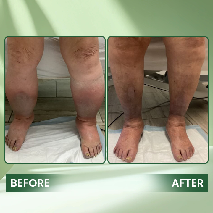 LIMETOW® Edema Relief Lotion