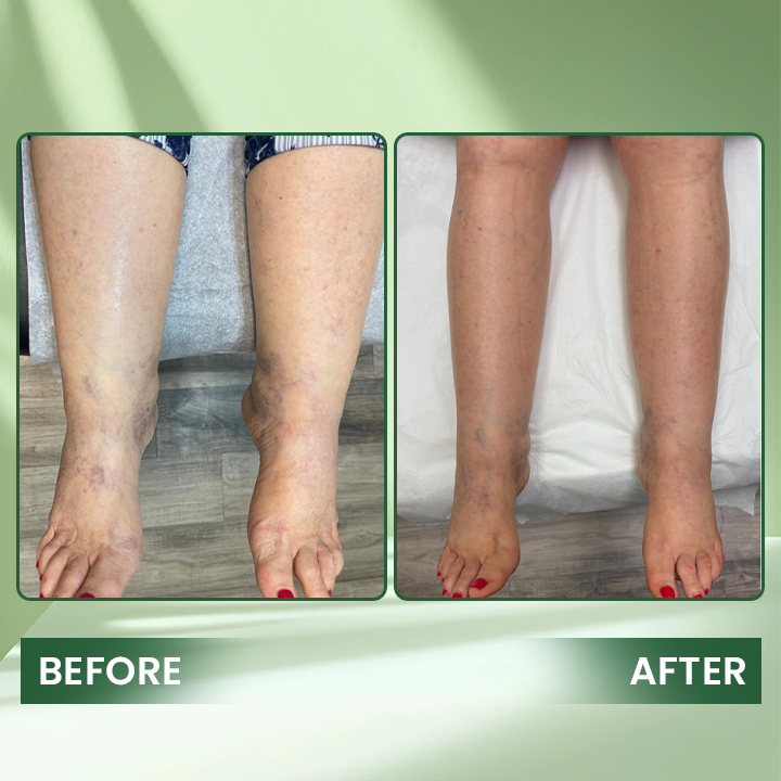 LIMETOW® Edema Relief Lotion