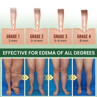 LIMETOW® Edema Relief Lotion