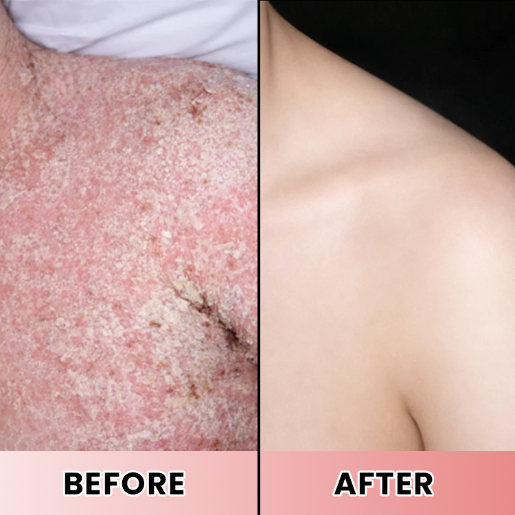 LIMETOW® Psoriasis Treatment Spray