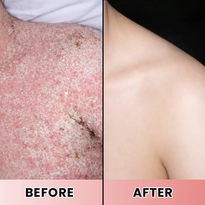 LIMETOW® Psoriasis Treatment Spray