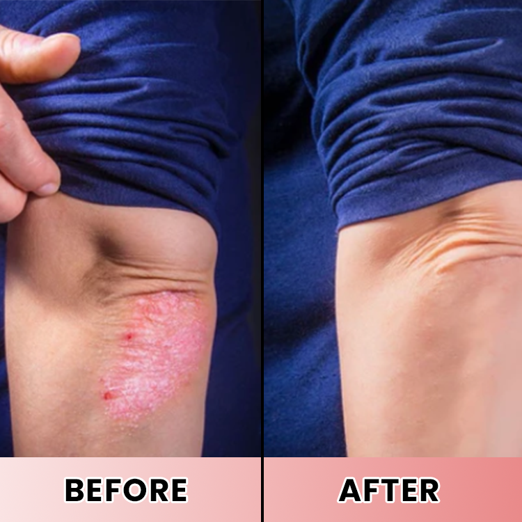 LIMETOW® Psoriasis Treatment Spray