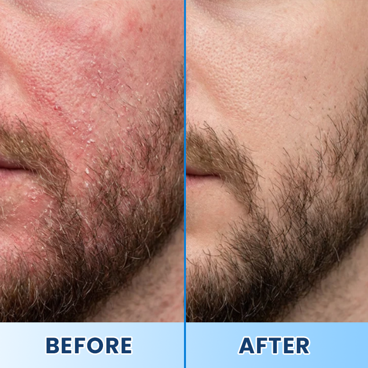 LIMETOW® Visible Beard & Scalp Relief in 7 Days Without Steroids