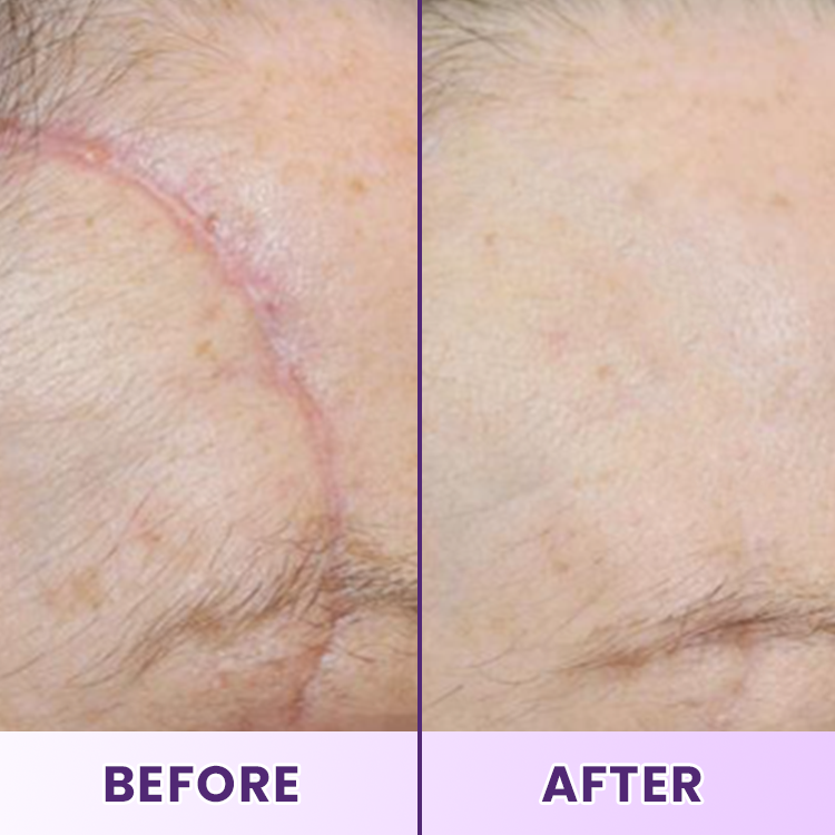 LIMETOW® ReGenScar Stem Cell Scar Gel