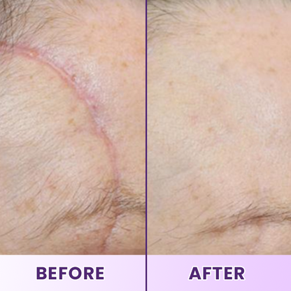 LIMETOW® ReGenScar Stem Cell Scar Gel