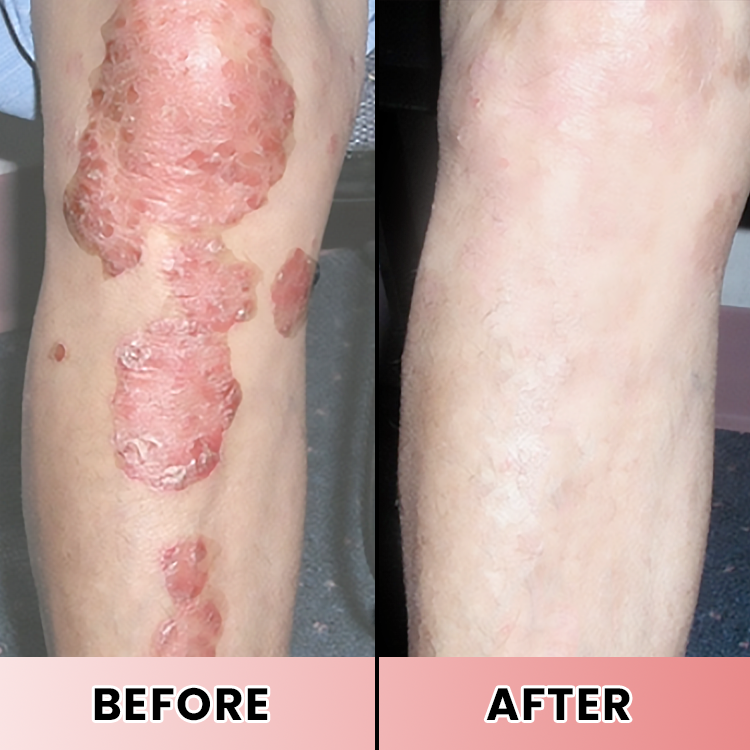 LIMETOW® Psoriasis Treatment Spray