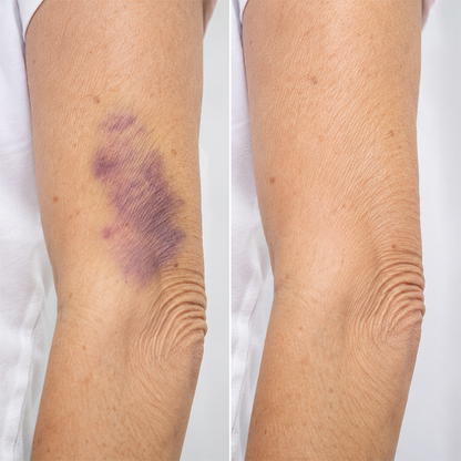 LIMETOW® Arnica Bruise Repair Oil Lotion