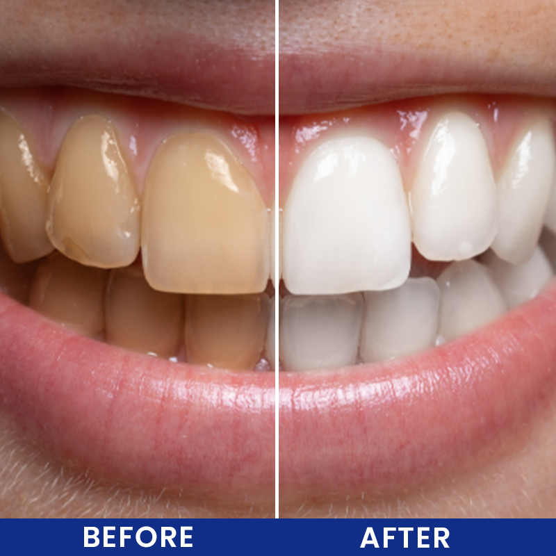 LIMETOW® Cavity Healing Tooth Armor