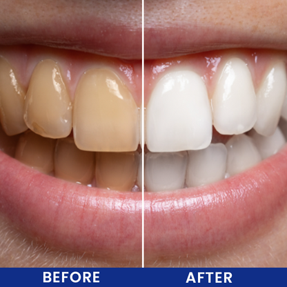 LIMETOW® Cavity Healing Tooth Armor