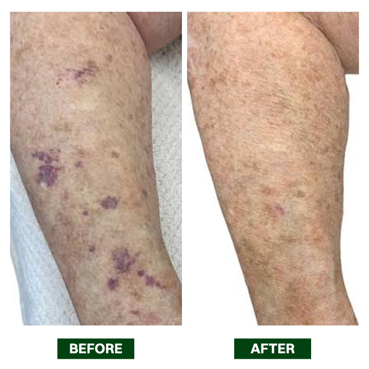 LIMETOW® Arnica Bruise Repair Oil Lotion