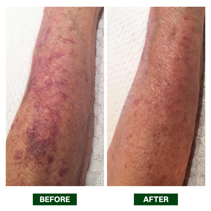 LIMETOW® Arnica Bruise Repair Oil Lotion