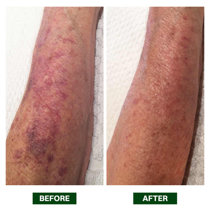 LIMETOW® Arnica Bruise Repair Oil Lotion