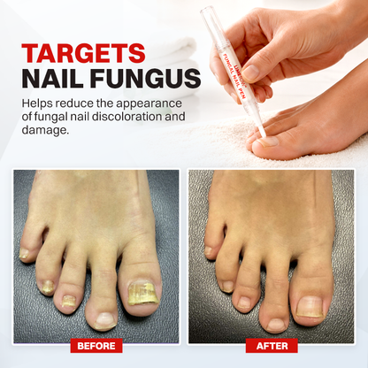LIMETOW® Fungal Nail Pen