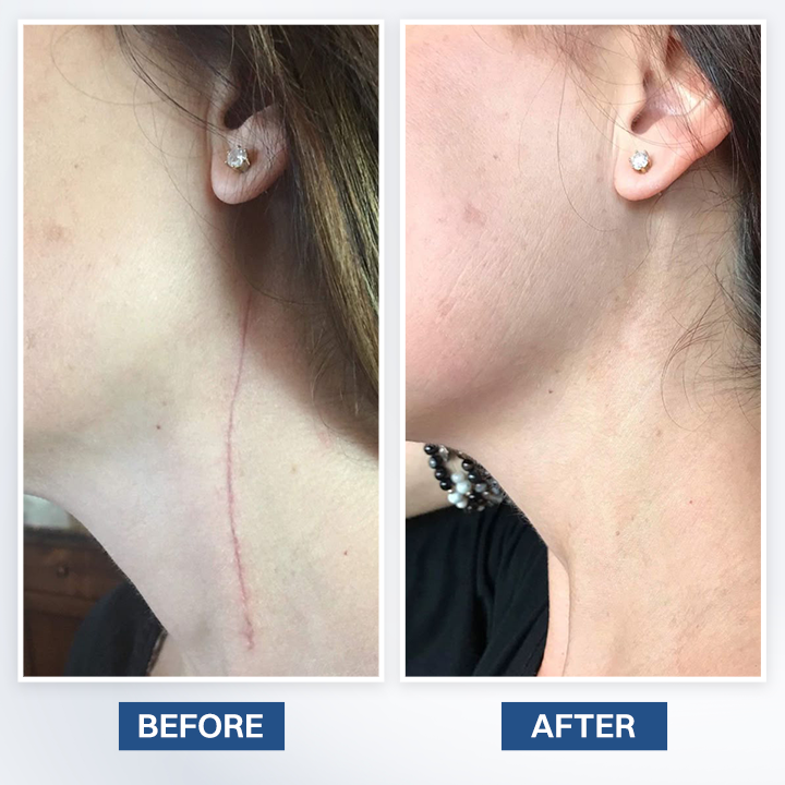 LIMETOW® Scar Removal Cream
