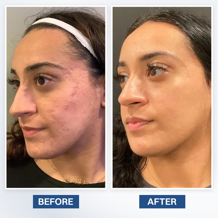 LIMETOW® Scar Removal Cream