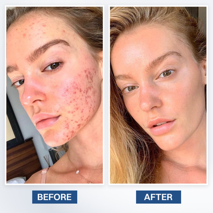 LIMETOW® Scar Removal Cream