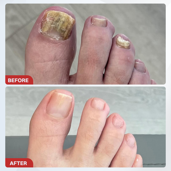 LIMETOW® Fungal Nail Pen