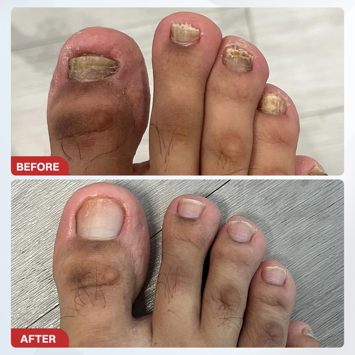 LIMETOW® Fungal Nail Pen