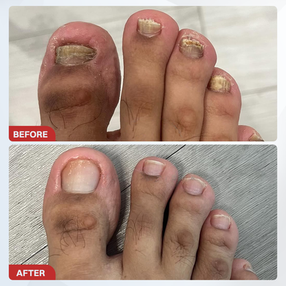 LIMETOW® Fungal Nail Pen
