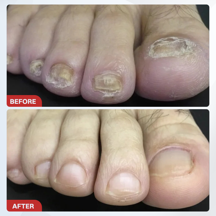 LIMETOW® Fungal Nail Pen