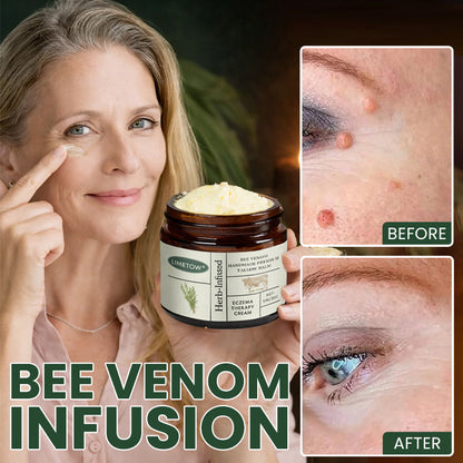 LIMETOW® Bee Venom Handmade Premium Tallow Balm – Herb-Infused Eczema Therapy Cream