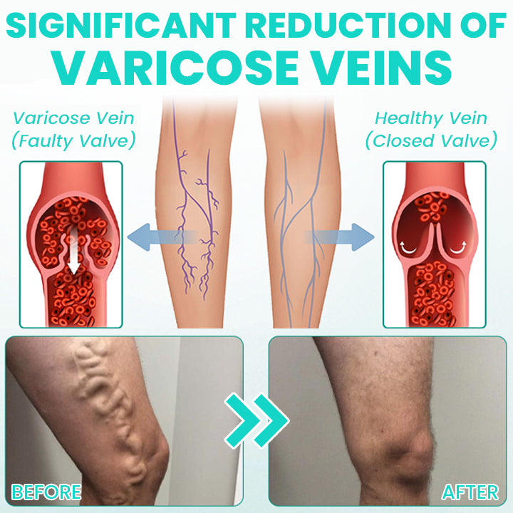LIMETOW® LegResume Varicose Veins Patch