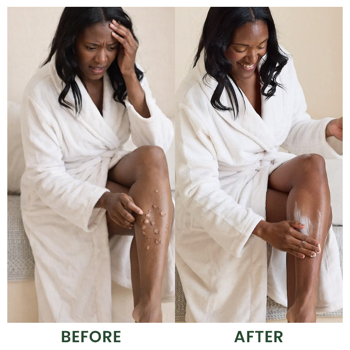 LIMETOW® Bee Venom Handmade Premium Tallow Balm – Herb-Infused Eczema Therapy Cream