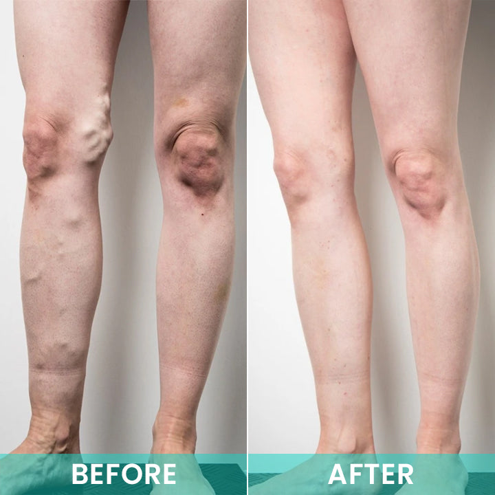 LIMETOW® LegResume Varicose Veins Patch