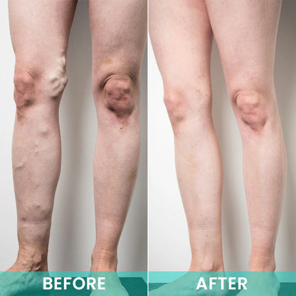 LIMETOW® LegResume Varicose Veins Patch
