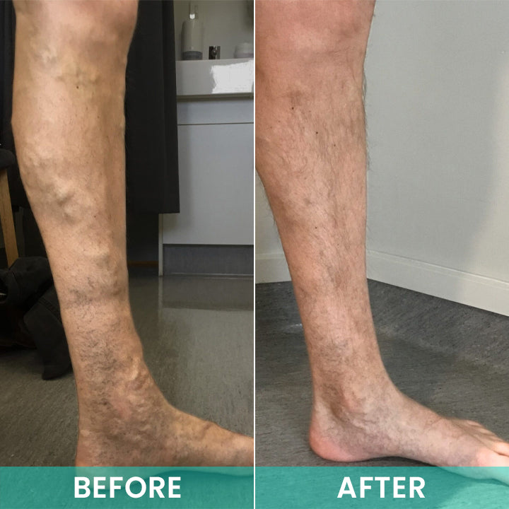 LIMETOW® LegResume Varicose Veins Patch