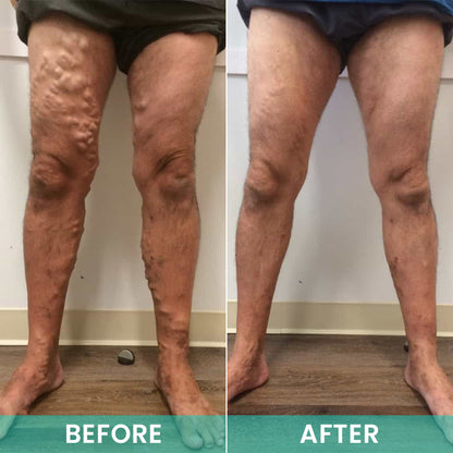 LIMETOW® LegResume Varicose Veins Patch